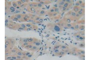 IHC-P analysis of Human Liver Cancer Tissue, with DAB staining. (IFNAR1 Antikörper  (AA 28-227))