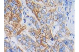 Detection of CYFRA21-1 in Human Breast cancer Tissue using Polyclonal Antibody to Cytokeratin Fragment Antigen 21-1 (CYFRA21-1)