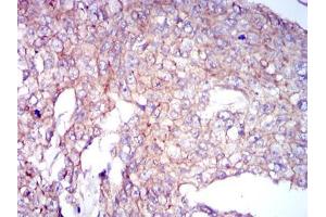 Immunohistochemical analysis of paraffin-embedded breast cancer tissues using COTL1 mouse mAb with DAB staining. (COTL1 Antikörper)