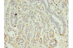 Immunohistochemistry of paraffin-embedded human breast cancer using ABIN7157263 at dilution of 1:100