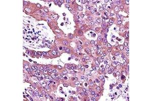 JAK2 antibody immunohistochemistry analysis in formalin fixed and paraffin embedded human lung adenocarcinoma. (JAK2 Antikörper  (AA 666-694))
