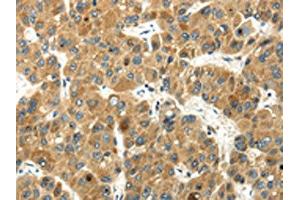 The image on the left is immunohistochemistry of paraffin-embedded Human liver cancer tissue using ABIN7193045(WFDC1 Antibody) at dilution 1/35, on the right is treated with synthetic peptide. (WFDC1 Antikörper)
