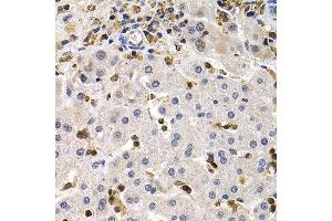 Immunohistochemistry of paraffin-embedded human liver cancer using BCL11A antibody at dilution of 1:200 (400x lens). (BCL11A Antikörper)