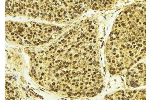 ABIN6268947 at 1/100 staining Human breast cancer tissue by IHC-P.