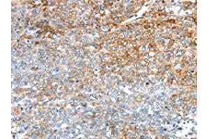 The image on the left is immunohistochemistry of paraffin-embedded Human ovarian cancer tissue using ABIN7192909(TRIM47 Antibody) at dilution 1/30, on the right is treated with synthetic peptide. (TRIM47 Antikörper)