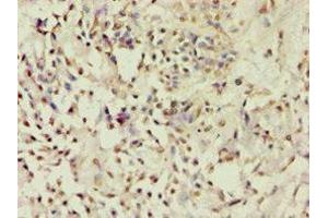 Immunohistochemistry of paraffin-embedded human breast cancer using ABIN7143182 at dilution of 1:100 (ACVR2B Antikörper  (AA 19-140))