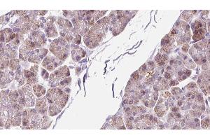 ABIN6273299 at 1/100 staining Human pancreas cancer tissue by IHC-P. (PMM2 Antikörper  (C-Term))