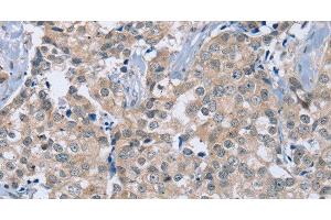 Immunohistochemistry of paraffin-embedded Human breast cancer using RAB8B Polyclonal Antibody at dilution of 1:40