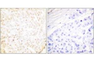 Immunohistochemistry analysis of paraffin-embedded human breast carcinoma tissue, using XRCC5 Antibody. (X-Ray Repair Cross Complementing 5 (AA 683-732) Antikörper)