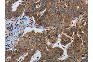 The image on the left is immunohistochemistry of paraffin-embedded Human ovarian cancer tissue using ABIN7192614(SPAG4 Antibody) at dilution 1/50, on the right is treated with synthetic peptide. (SPAG4 Antikörper)