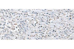 Immunohistochemistry of paraffin-embedded Human liver cancer tissue using EPM2A Polyclonal Antibody at dilution of 1:55(x200) (EPM2A Antikörper)