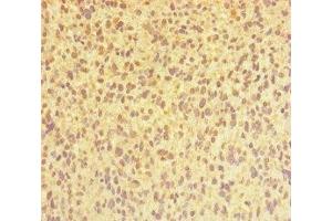 Immunohistochemistry of paraffin-embedded human glioma using ABIN7147689 at dilution of 1:100