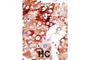 Formalin-fixed and paraffin-embedded human hepatocellular carcinoma tissue reacted with the ACSL4 polyclonal antibody  , which was peroxidase-conjugated to the secondary antibody, followed by DAB staining. (ACSL4 Antikörper  (AA 244-274))