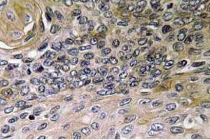 Immunohistochemistry (IHC) analyzes of IL-8 antibody in paraffin-embedded human lung carcinoma tissue. (IL-8 Antikörper)