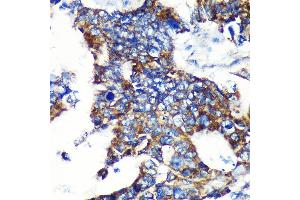 Immunohistochemistry of paraffin-embedded Human colon carcinoma using ESPN Rabbit pAb (ABIN7267008) at dilution of 1:100 (40x lens). (Espin Antikörper  (AA 585-854))