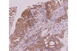 Immunohistochemistry paraffin embedded sections of human colorectal cancer tissue were incubated with monoclonal CLEC4E monoclonal antibody, clone AT16E3  (1 : 50) for 2 hours at room temperature.