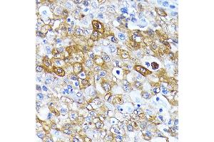 Immunohistochemistry of paraffin-embedded human esophageal cancer using  antibody  at dilution of 1:100 (40x lens). (ATG7 Antikörper)