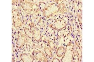 Immunohistochemistry of paraffin-embedded human gastric cancer using ABIN7160996 at dilution of 1:100