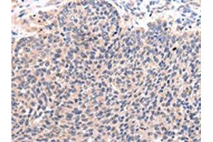 The image on the left is immunohistochemistry of paraffin-embedded Human lung cancer tissue using ABIN7190092(CCL7 Antibody) at dilution 1/20, on the right is treated with synthetic peptide. (CCL7 Antikörper)