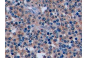 Detection of CD7 in Human Lymphoma Tissue using Polyclonal Antibody to Cluster Of Differentiation 7 (CD7) (CD7 Antikörper  (AA 26-134))