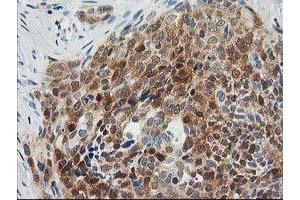 Immunohistochemical staining of paraffin-embedded Adenocarcinoma of Human breast tissue using anti-OSBP mouse monoclonal antibody. (OSBP Antikörper)