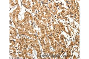 Immunohistochemistry of Human thyroid cancer using MAP1A Polyclonal Antibody at dilution of 1:40 (MAP1A Antikörper)