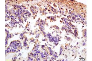 Formalin-fixed and paraffin embedded human rectal carcinoma labeled with Anti MCP1/CCL2 Polyclonal Antibody (ABIN675863), Unconjugated at 1:200, followed by conjugation to the secondary antibody and DAB staining (CCL2 Antikörper)