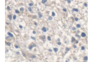Detection of ME2 in Human Glioma Tissue using Polyclonal Antibody to Malic Enzyme 2, NADP+ Dependent, Mitochondrial (ME2) (Malic Enzyme 2, NADP+ Dependent, Mitochondrial (AA 220-426) Antikörper)