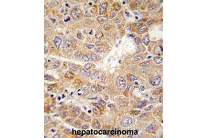 Formalin-fixed and paraffin-embedded human hepatocarcinomareacted with PGK1 polyclonal antibody , which was peroxidase-conjugated to the secondary antibody, followed by AEC staining. (PGK1 Antikörper  (Internal Region))