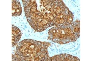 IHC testing of FFPE human colon carcinoma with MAML3 antibody (clone MMLP3-1). (MAML3 Antikörper)