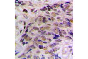 Immunohistochemical analysis of HES6 staining in human prostate cancer formalin fixed paraffin embedded tissue section. (HES6 Antikörper  (N-Term))