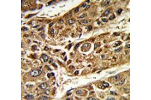 Immunohistochemistry analysis of human hepatocarcinoma (Formalin-fixed, Paraffin-embedded) using MTTP Antibody (C-term), followed by peroxidase-conjugated secondary antibody and DAB staining.