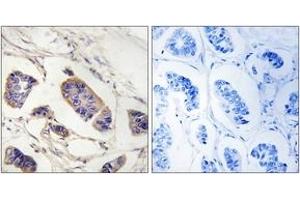 Immunohistochemistry analysis of paraffin-embedded human breast carcinoma tissue, using PEX7 Antibody. (PEX7 Antikörper  (AA 204-253))