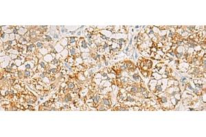 Immunohistochemistry of paraffin-embedded Human liver cancer tissue using SH3YL1 Polyclonal Antibody at dilution of 1:55(x200) (SH3YL1 Antikörper)