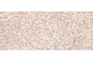 Immunohistochemistry of paraffin-embedded Human ovarian cancer tissue using FAN1 Polyclonal Antibody at dilution of 1:30(x200) (FAN1 Antikörper)
