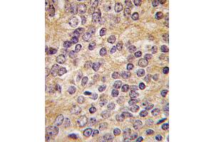 Formalin-fixed and paraffin-embedded human prostata carcinoma tissue reacted with PLAU antibody (C-term ), which was peroxidase-conjugated to the secondary antibody, followed by DAB staining. (PLAU Antikörper  (C-Term))