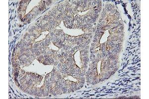 Immunohistochemical staining of paraffin-embedded Adenocarcinoma of Human endometrium tissue using anti-RTN4IP1 mouse monoclonal antibody. (RTN4IP1 Antikörper  (AA 41-279))