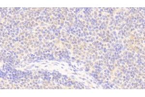 Detection of APBB1IP in Human Lymph node Tissue using Polyclonal Antibody to Amyloid Beta Precursor Protein Binding B1 Interacting Protein (APBB1IP) (Amyloid beta (A4) Precursor Protein-Binding, Family B, Member 1 Interacting Protein (APBB1IP) (AA 188-421) Antikörper)