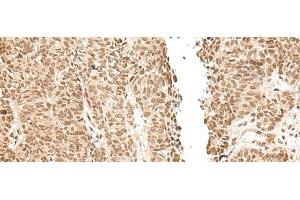Immunohistochemistry of paraffin-embedded Human ovarian cancer tissue using LGALS4 Polyclonal Antibody at dilution of 1:30(x200) (GAL4 Antikörper)