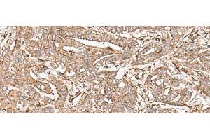 Immunohistochemistry of paraffin-embedded Human liver cancer tissue using FAAP24 Polyclonal Antibody at dilution of 1:30(x200) (FAAP24 Antikörper)