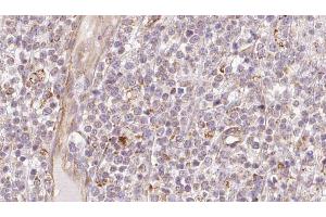 ABIN6273208 at 1/100 staining Human lymph cancer tissue by IHC-P. (CHCHD4 Antikörper  (N-Term))