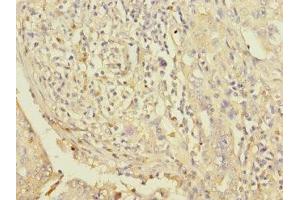 Immunohistochemistry of paraffin-embedded human lung cancer using ABIN7163118 at dilution of 1:100 (Lipin 1 Antikörper  (AA 741-890))