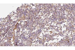 ABIN6276608 at 1/100 staining Human Melanoma tissue by IHC-P.