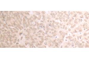 Immunohistochemistry of paraffin-embedded Human ovarian cancer tissue using TRMT1 Polyclonal Antibody at dilution of 1:25(x200) (TRMT1 Antikörper)