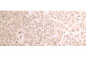 Immunohistochemistry of paraffin-embedded Human ovarian cancer tissue using TRMT1 Polyclonal Antibody at dilution of 1:25(x200) (TRMT1 Antikörper)