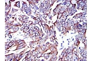 Immunohistochemical analysis of paraffin-embedded human stomach cancer tissues using KRT19 mouse mAb with DAB staining.
