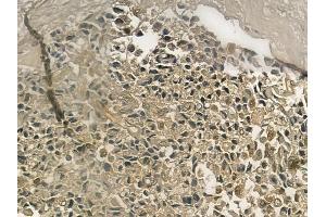 ABIN6257045 and ABIN6275049 at 1/100 staining human prostate carcinoma by IHC-P.