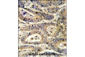 Formalin-fixed and paraffin-embedded human colon carcinoma reacted with IGFBP6 Antibody (C-term), which was peroxidase-conjugated to the secondary antibody, followed by DAB staining. (IGFBP6 Antikörper  (C-Term))