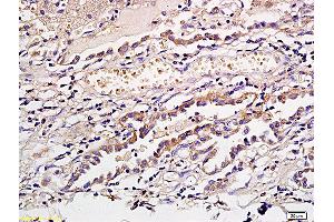 Formalin-fixed and paraffin embedded human gastric cancer labeled with Anti CD1a/Cortical thymocyte antigen CD1A Polyclonal Antibody, Unconjugated (ABIN704096) at 1:300 followed by conjugation to the secondary antibody and DAB staining (CD1a Antikörper  (AA 151-250))