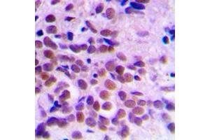 Immunohistochemical analysis of CDC2 staining in human breast cancer formalin fixed paraffin embedded tissue section. (CDK1 Antikörper  (Center))